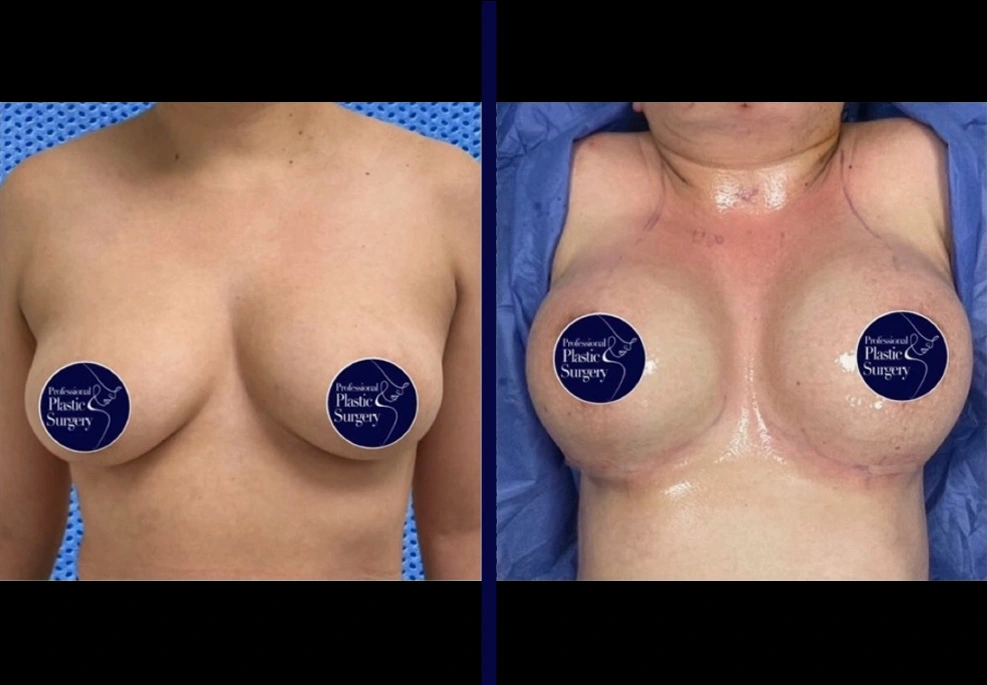 Breast Implants 1