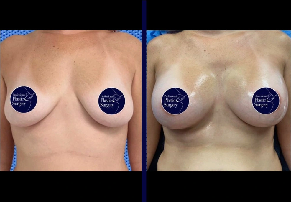 Breast Implants 2
