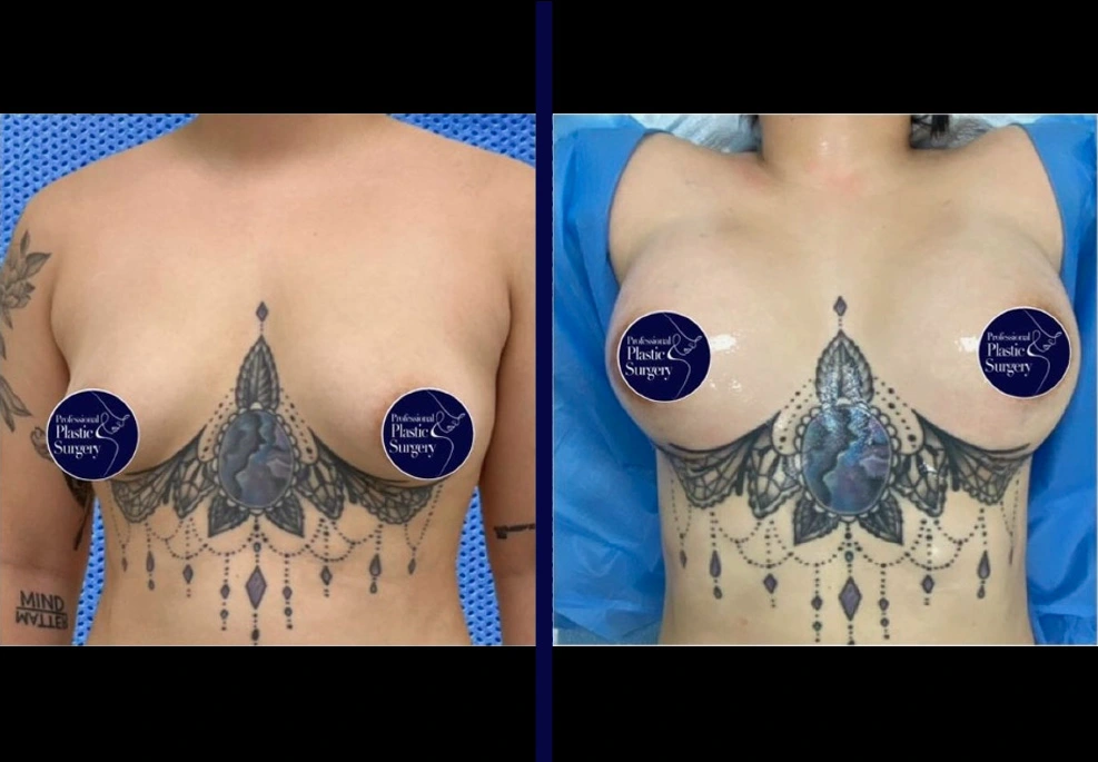 Breast Implants 3