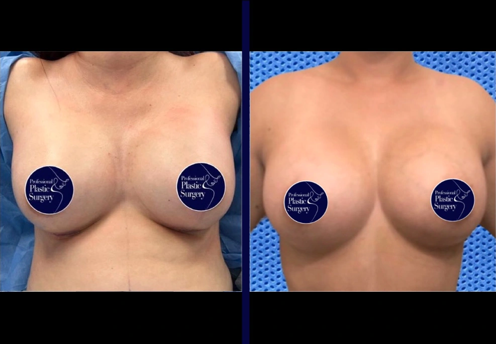 Breast Implants 5