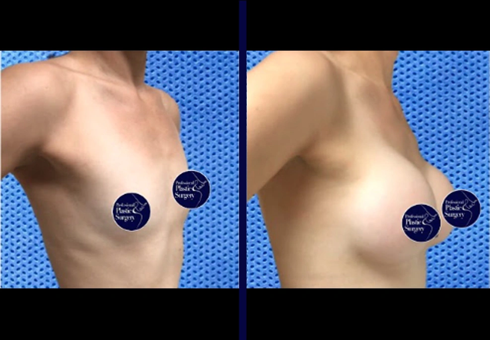 Breast Implants 6A