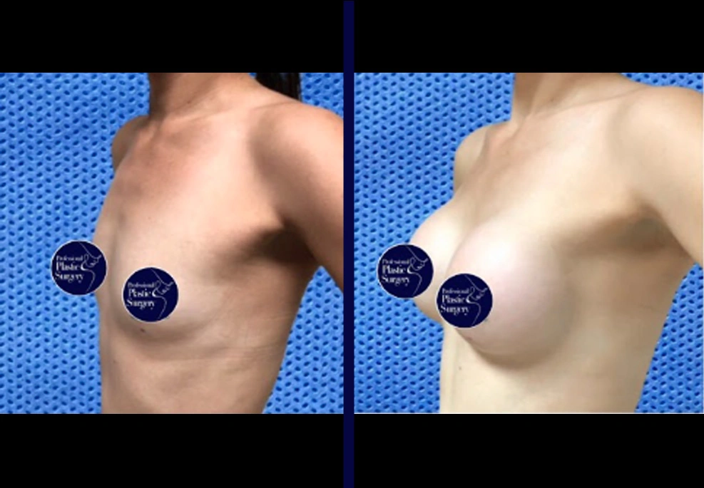 Breast Implants 6B