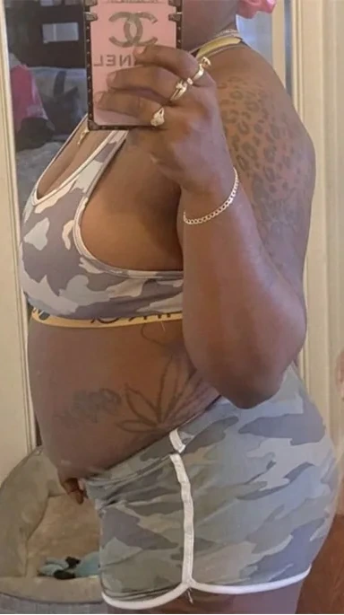 mommy-makeover-before-6